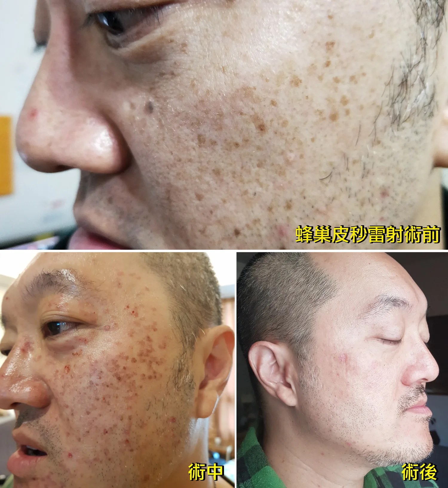 嘉義皮秒雷射除斑｜郭健軍皮膚科 老公蜂巢皮秒除雀斑曬斑實測