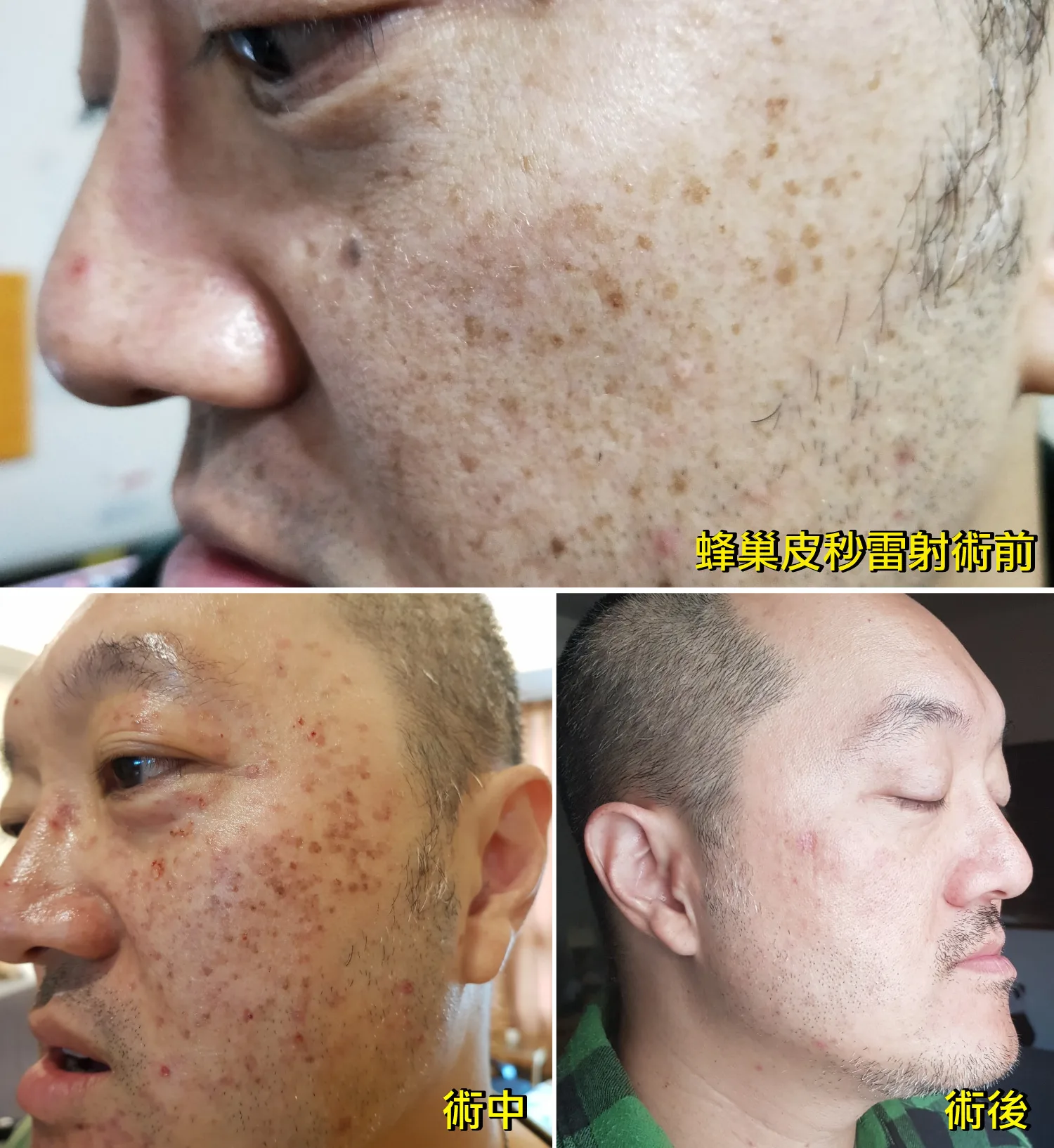 老公蜂巢皮秒雷射前的雀斑、曬斑