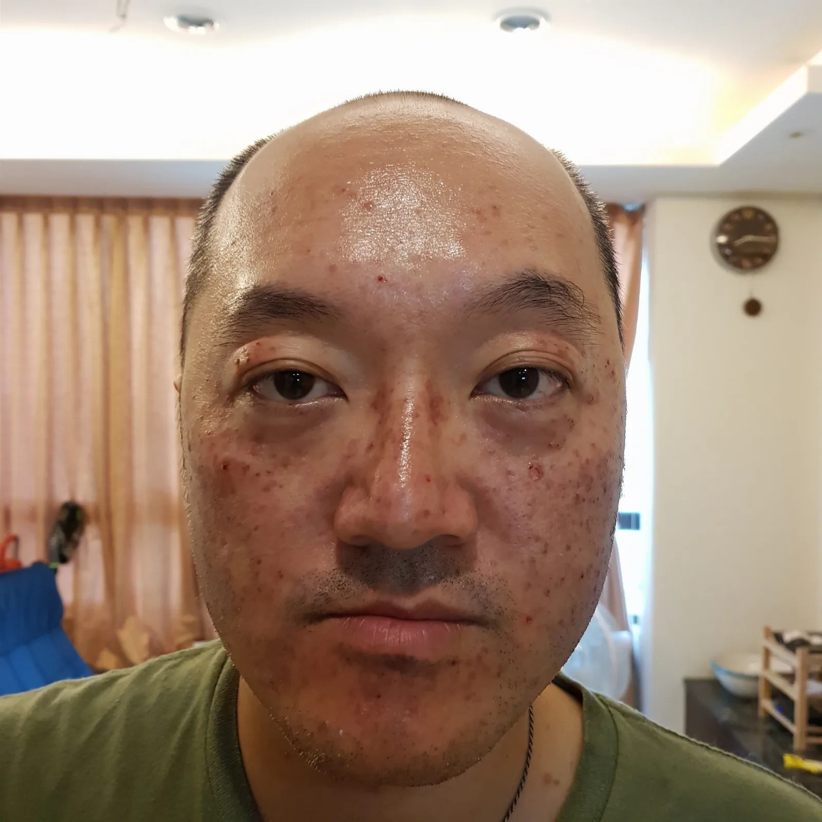 回家後整臉泛紅一點一點