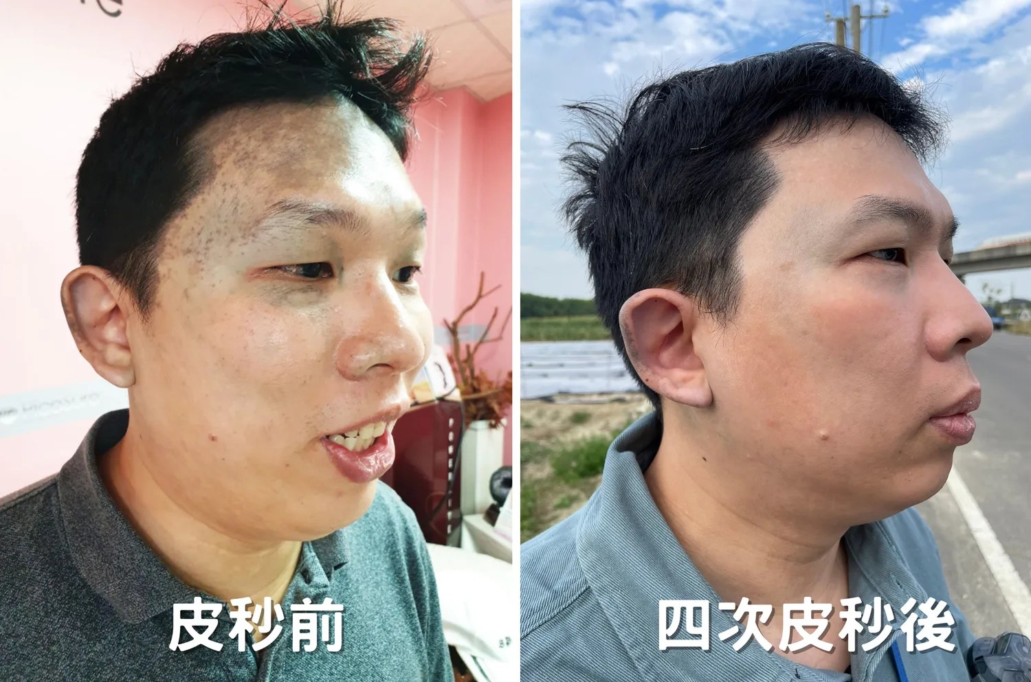 四次療程後的前後對比