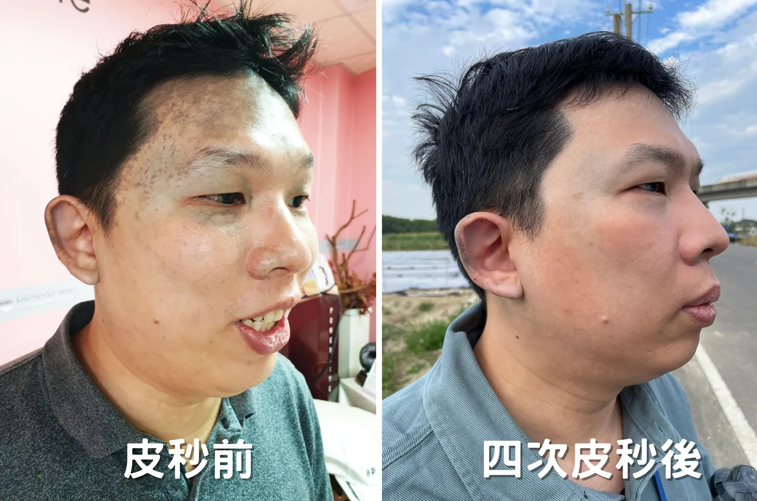 四次療程後的前後對比