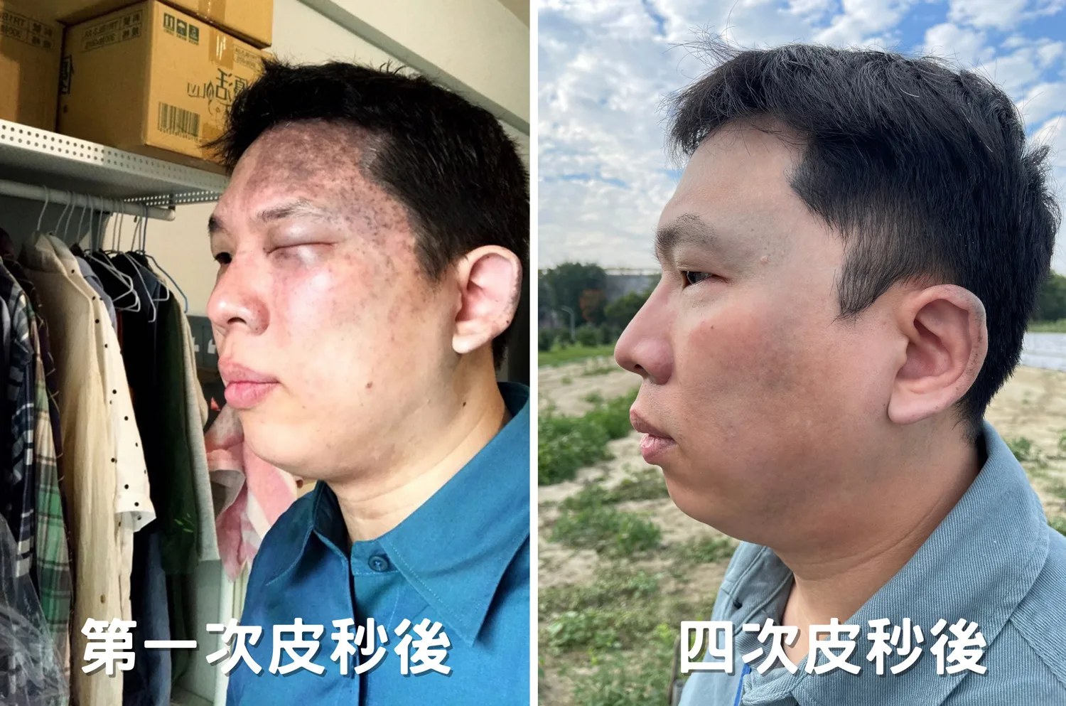 太田母斑大幅淡化