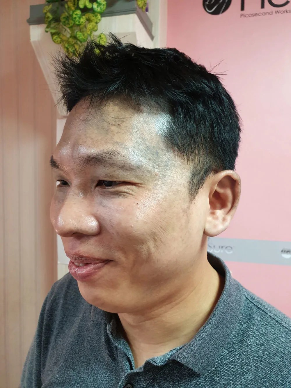 準備施打的部位