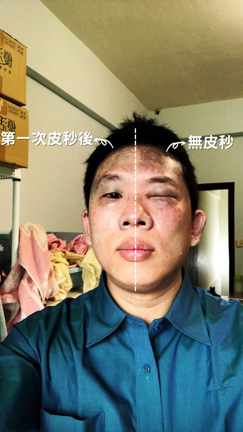 第一次後第一天，右半部已淡化
