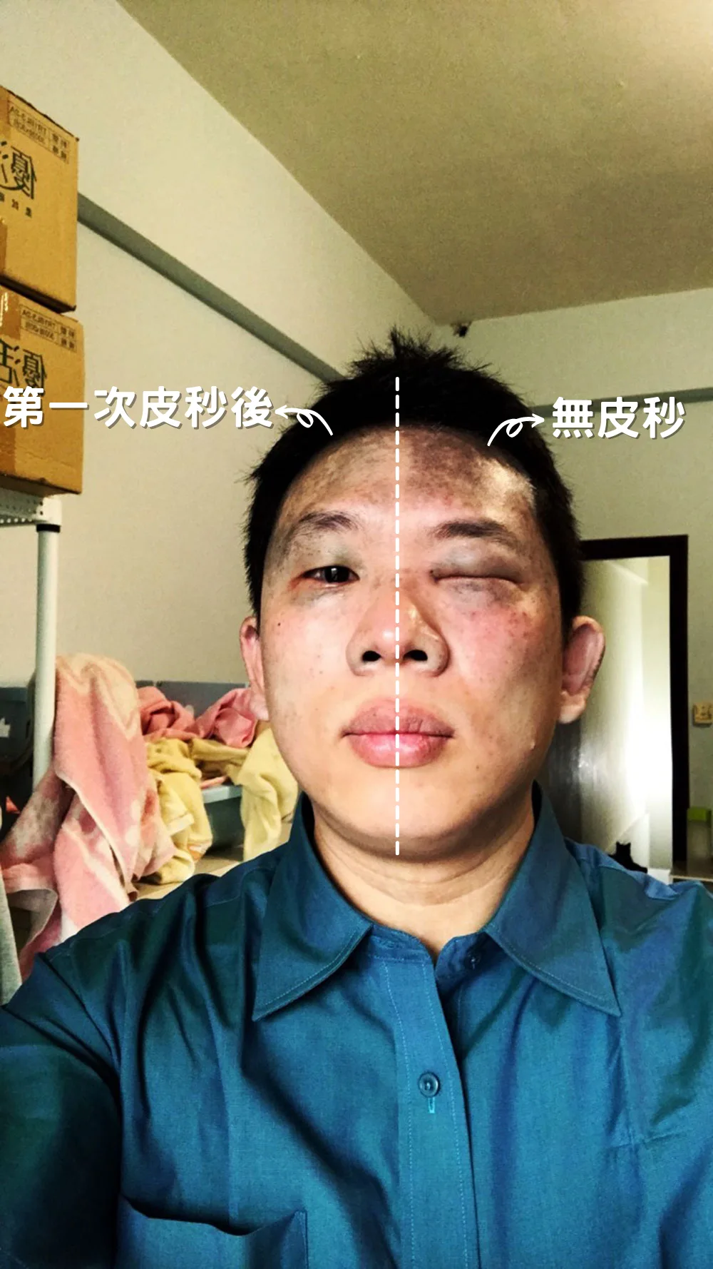 第一次後第一天，右半部已淡化