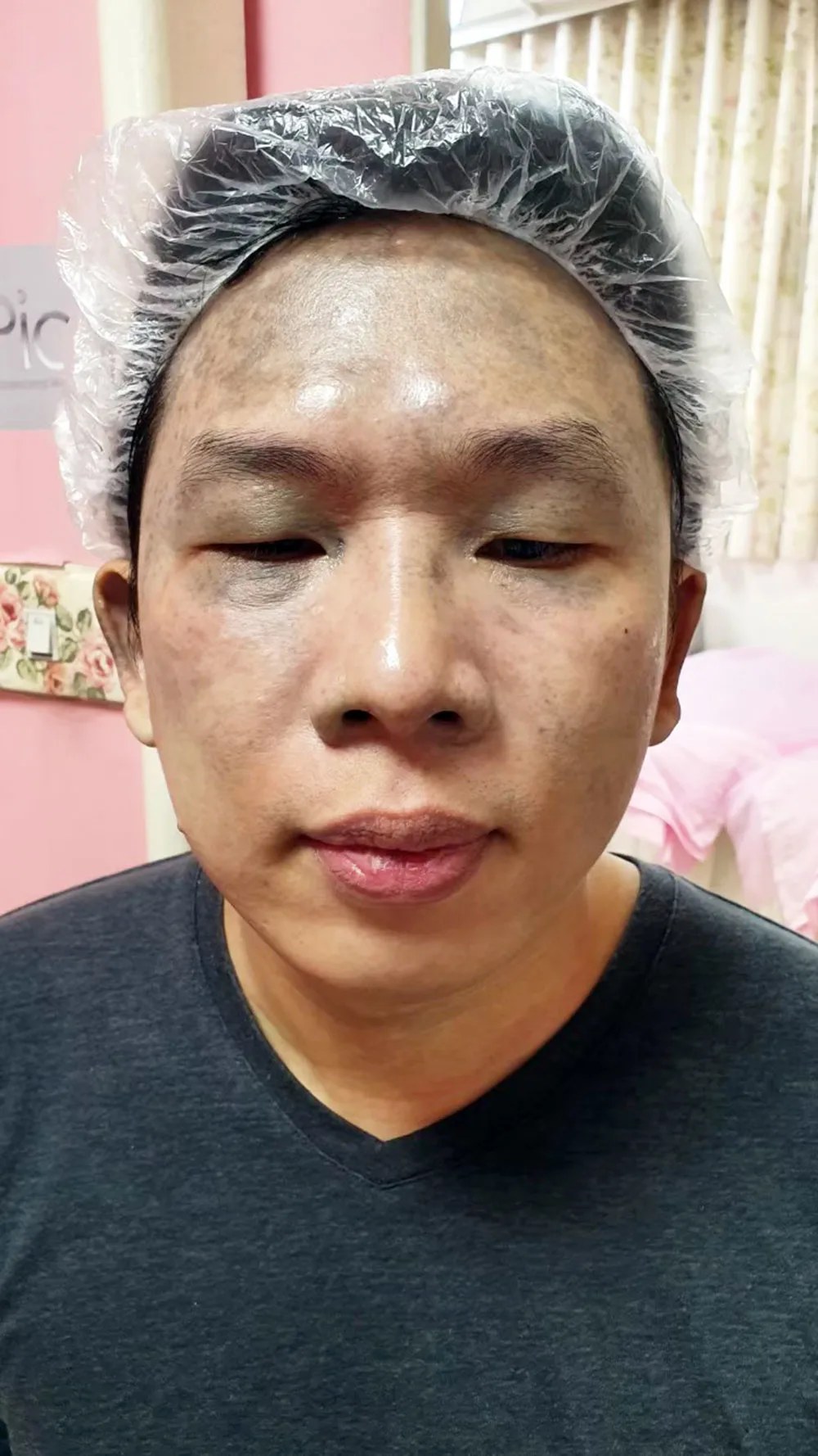第二次施打前，斑已淡化