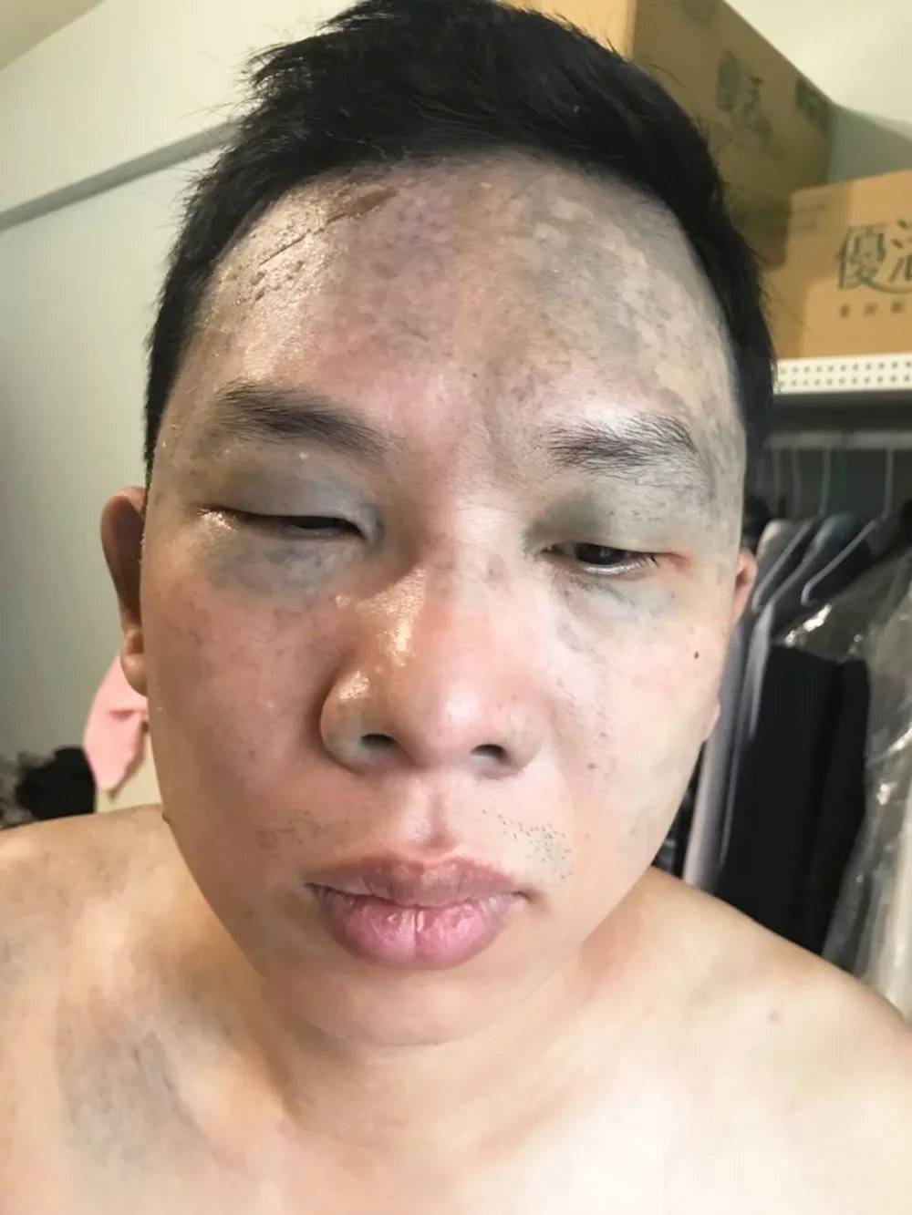 第二次後第五天，結痂脫落