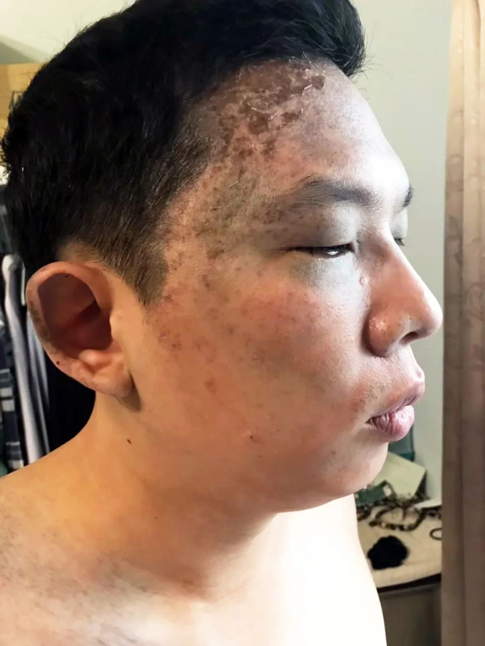 膚況持續改善