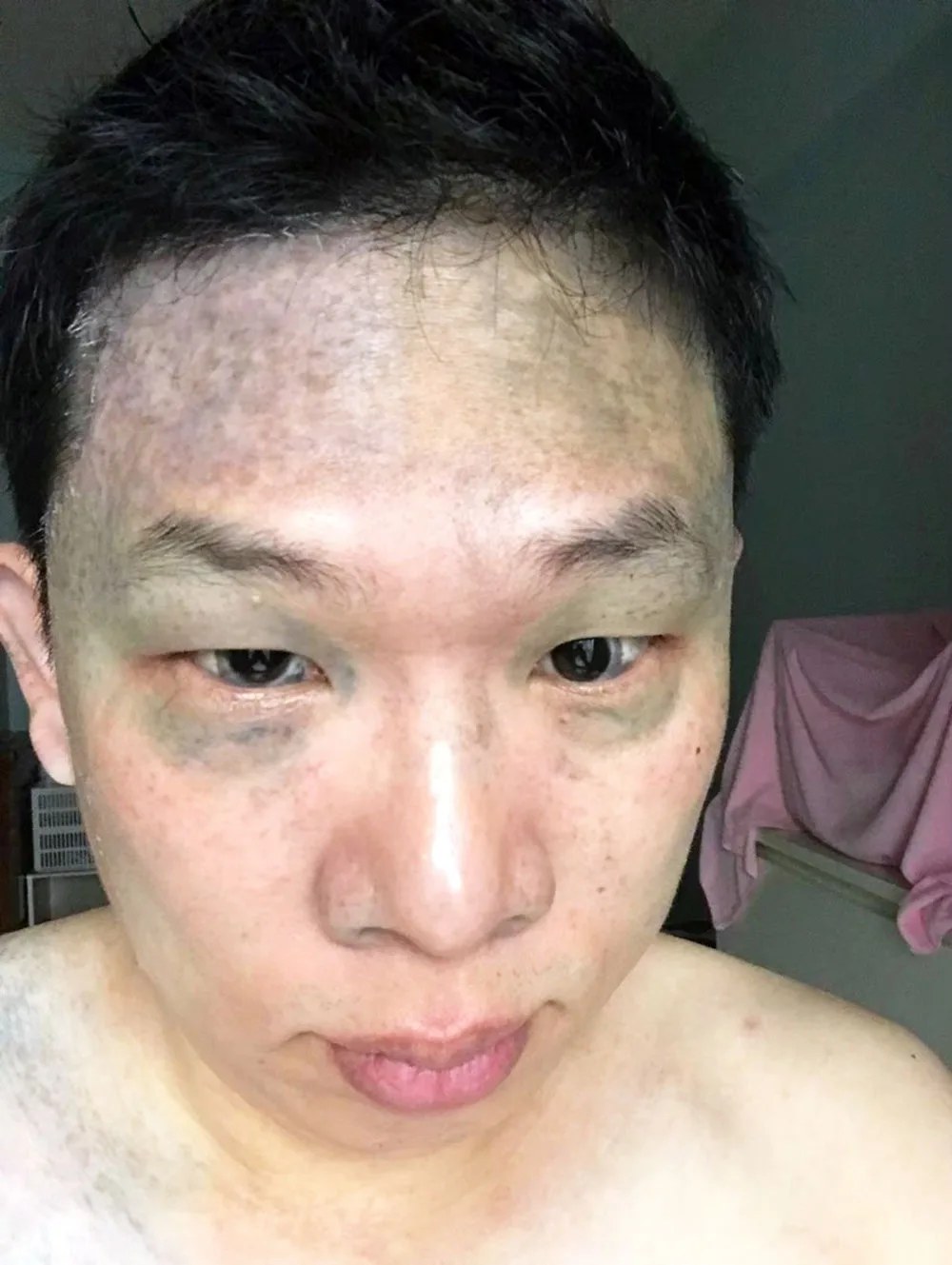 第六天，膚質明顯改善